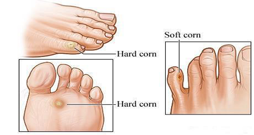 Drawing of different types of corns