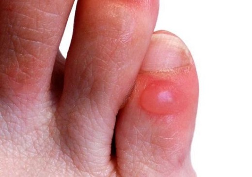 Foot blister