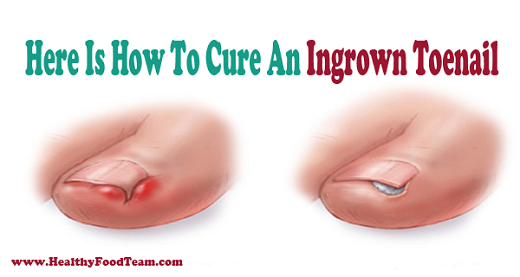 Ingrown Toenail Photo