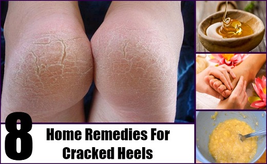 Home Remedies For Cracked Heels