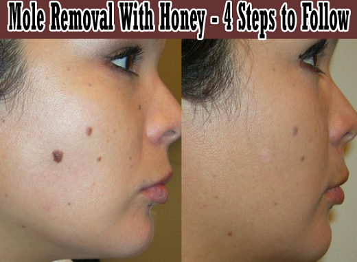 Profile of Woman Before and After Mole Removal With Honey