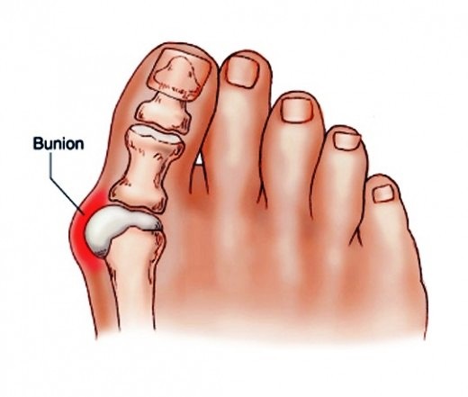 bunion drawing