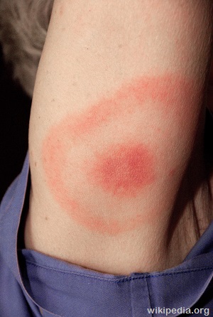 Lyme disease bull's eye