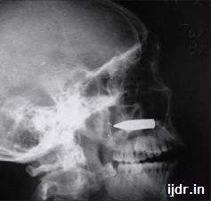 XRAY of gunshot head wound