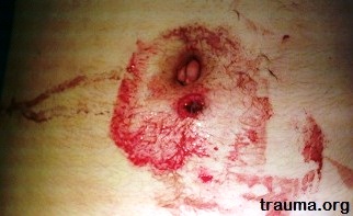 abdominal gunshot wound