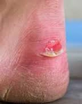 Feet blisters