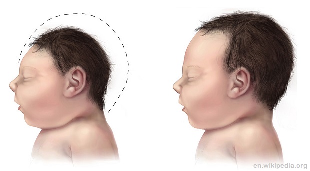 Microcephaly comparison 