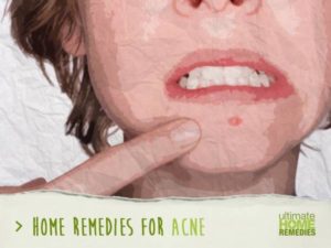 acne-feature-image-300x225